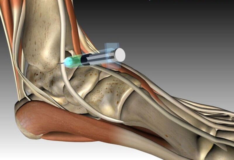 آسپیراسیون مفصل مچ پا برای کاهش درد و تورم