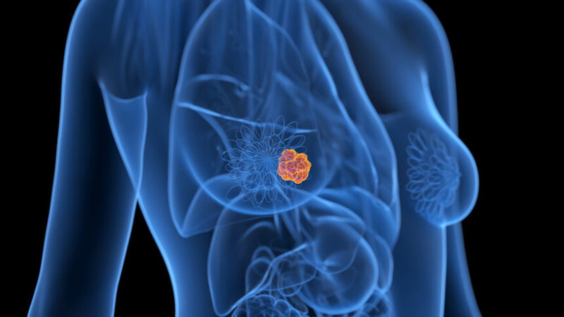 در بیماری سرطان سینه، سلول‌های سینه به طور غیر طبیعی رشد می‌کنند.