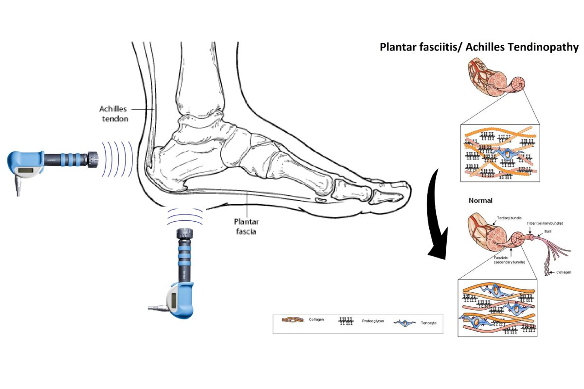 مبانی فیزیولوژیک شاک ویو تراپی برای درمان خار پاشنه پا