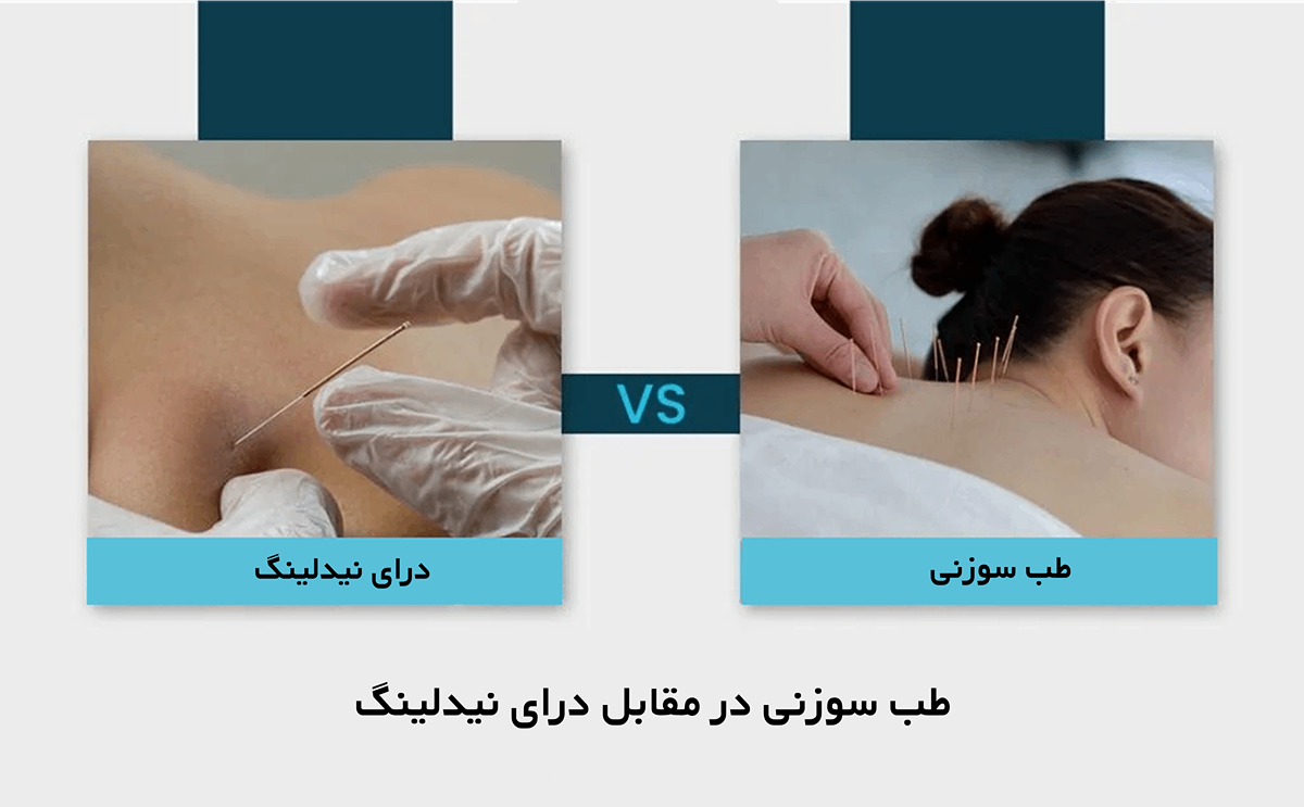 تفاوت طب سوزنی و درای نیدلینگ