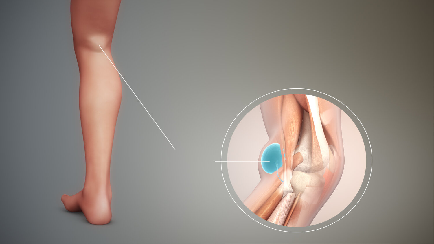 کیست بیکر (Baker's Cyst)