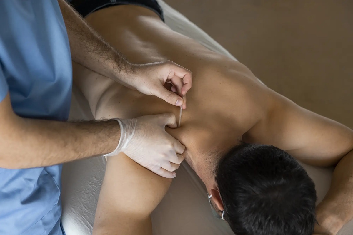 سوزن خشک برای سیاتیک