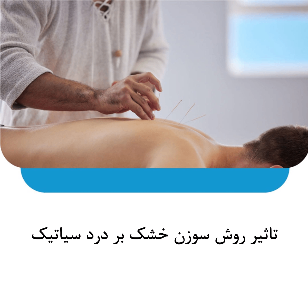 سوزن خشک برای سیاتیک