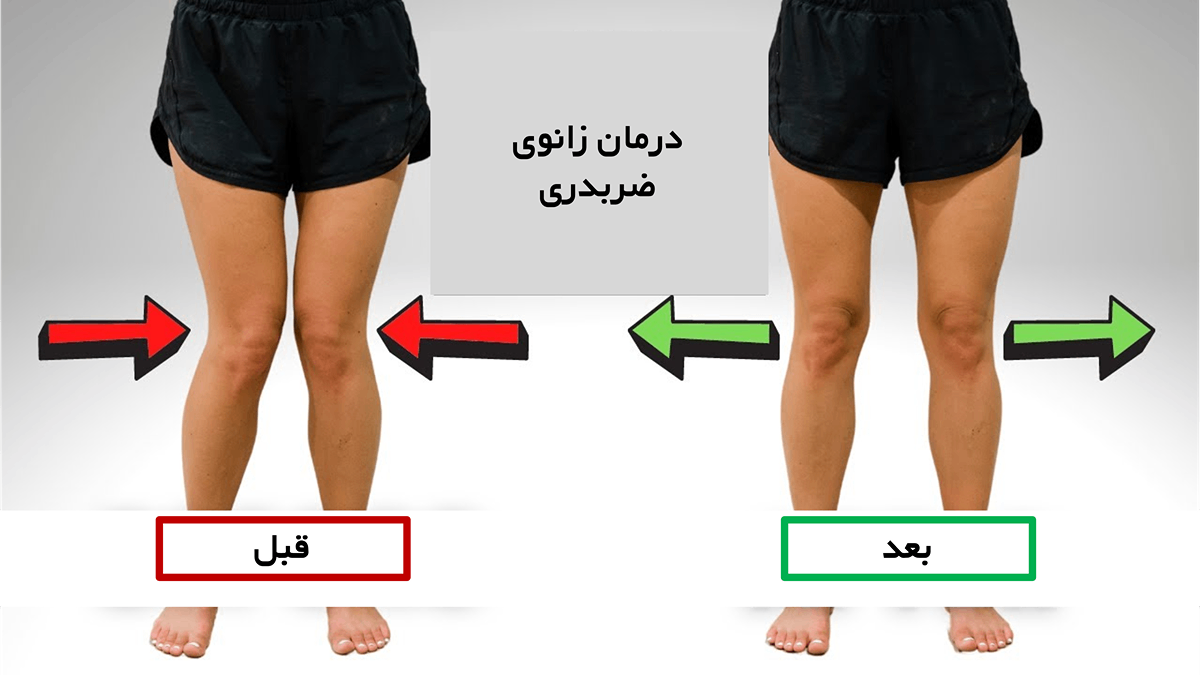 درمان زانوی ضربدری