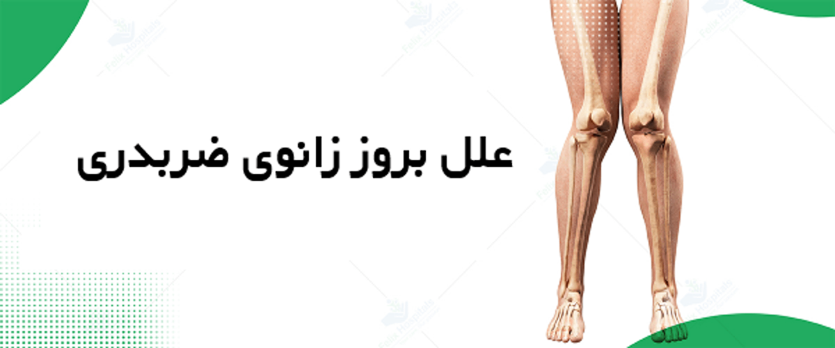 علل بروز زانوی ضربدری