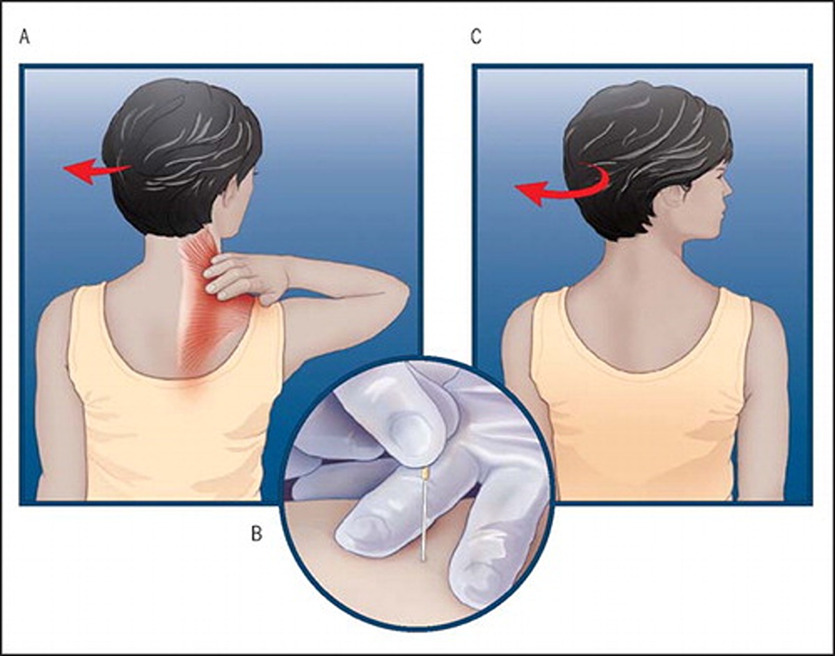 بهبود درد گردن با روش سوزن خشک