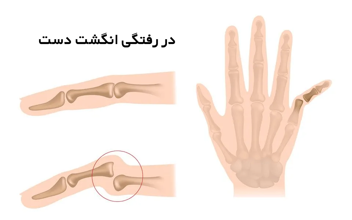 علائم در رفتگی انگشت دست