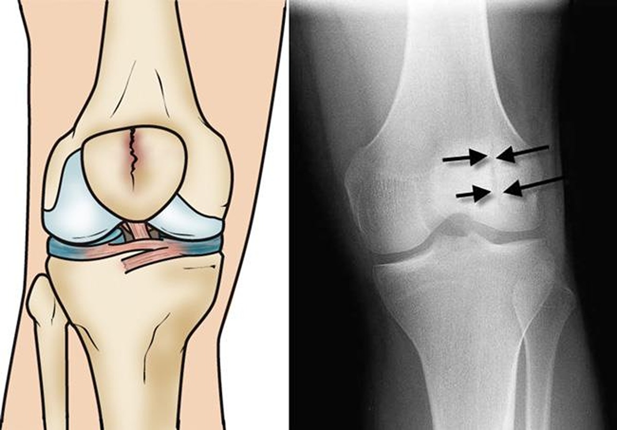 ساییدگی کشکک زانو چیست؟