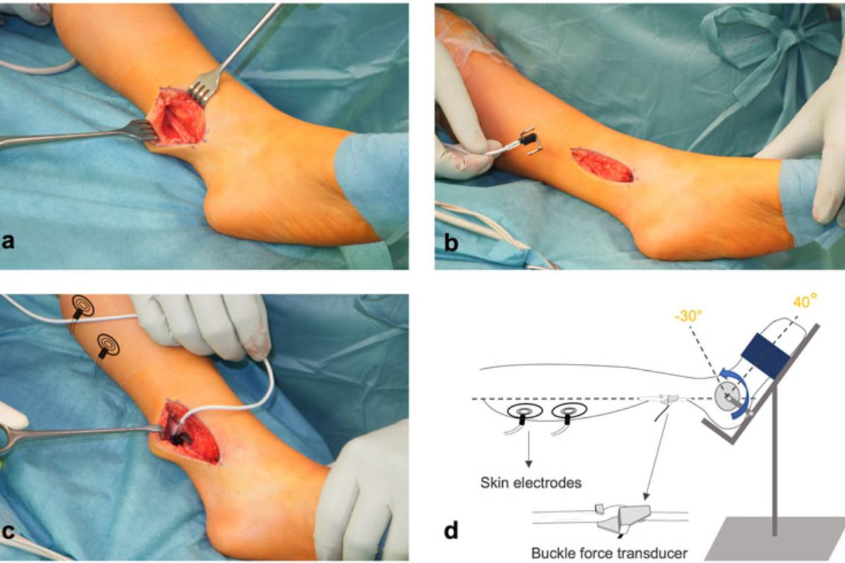 جراحی کوتاهی تاندون آشیل در کودکان