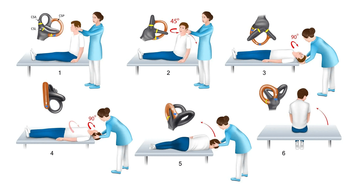 فیزیوتراپی برای درمان سرگیجه وضعیتی BPPV
