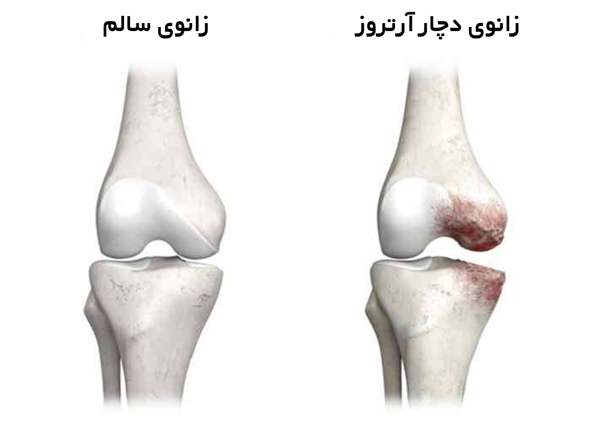 مقایسه زانوی سالم و ژانوی دچار آرتروز