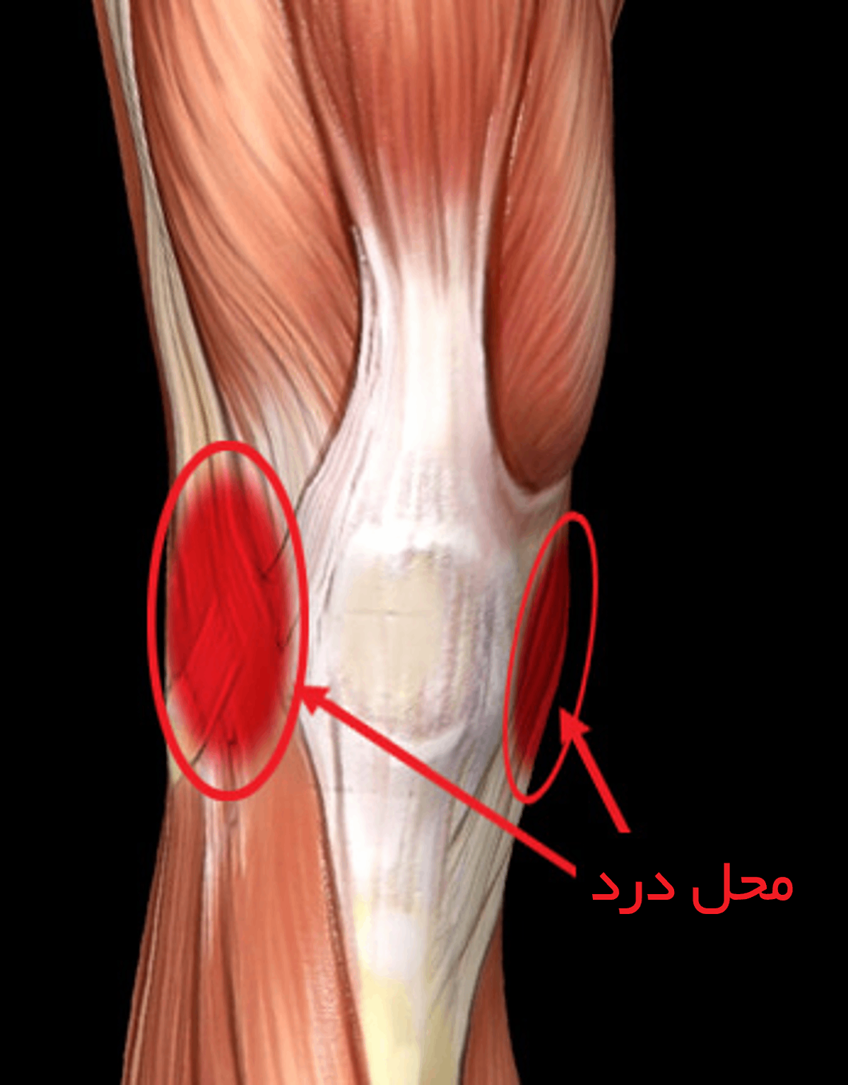 محل درد پارگی مینیسک