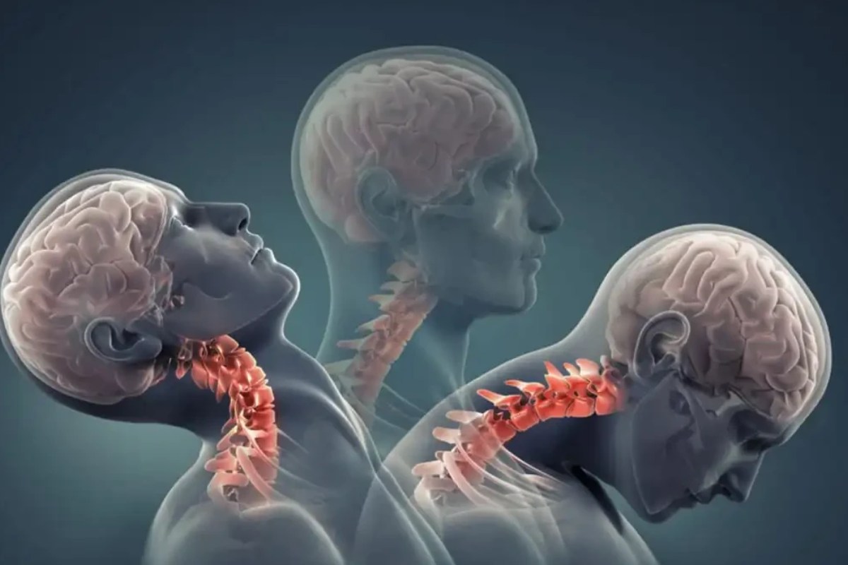 علائم آرتروز گردن