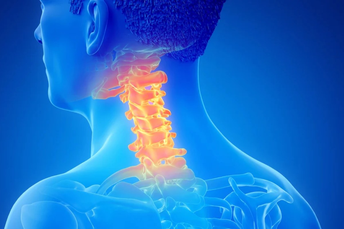 آرتروز گردن چیست