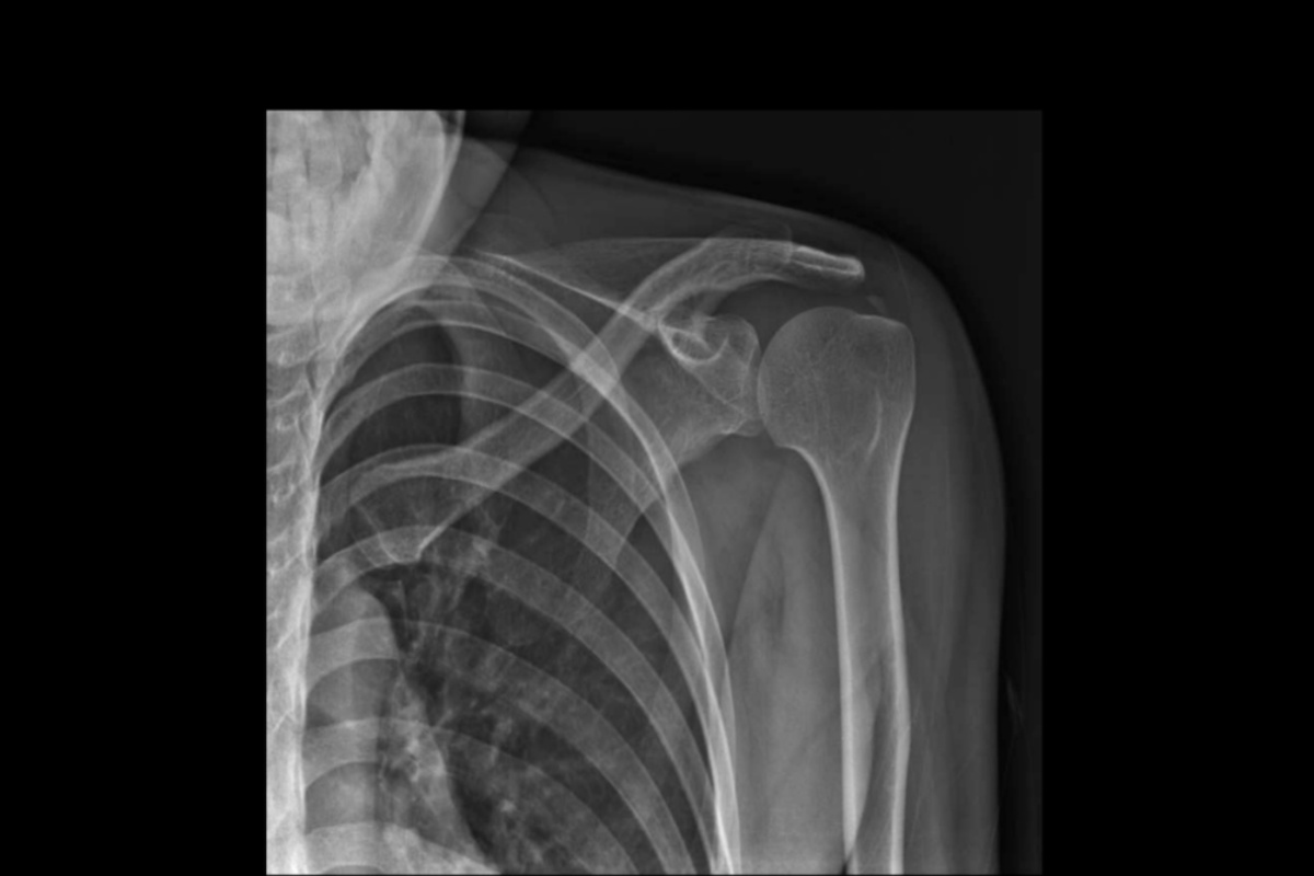 آناتومی و عملکرد تاندون سوپرااسپیناتوس