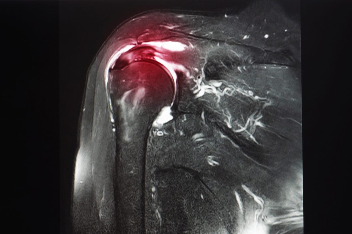 تشخیص پارگی تاندون سوپرااسپیناتوس