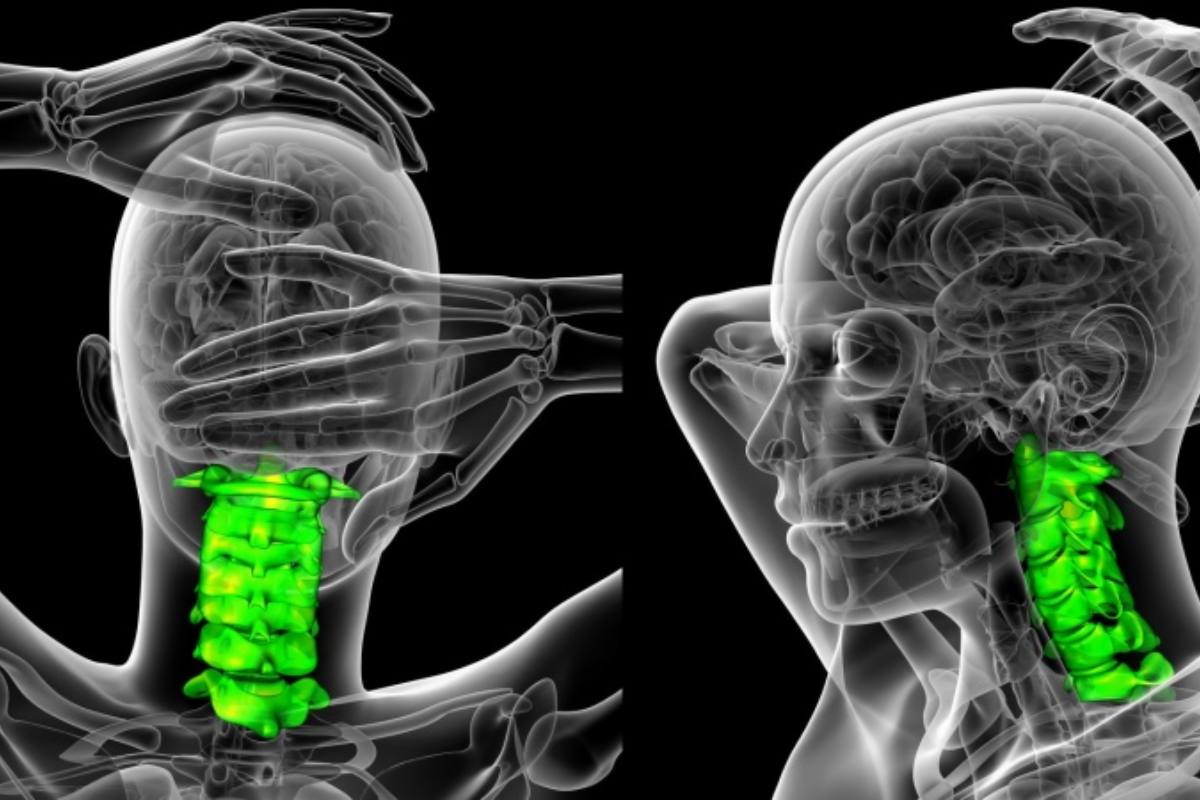 علائم آرتروز که روی اعصاب فشار می آورد