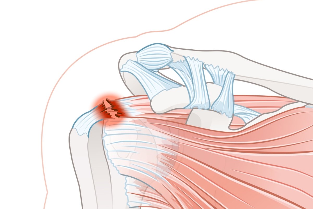 پارگی تاندون سوپرااسپیناتوس