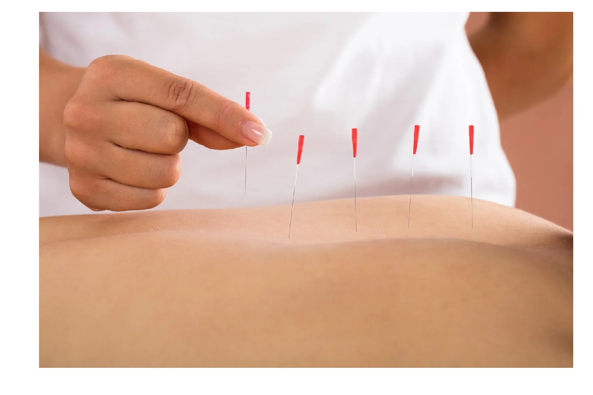 سوزن خشک برای دیسک کمر