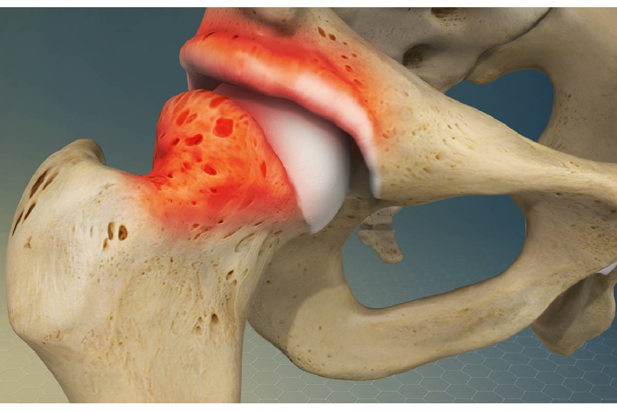 سندرم گیرافتادگی فمورو استابولار