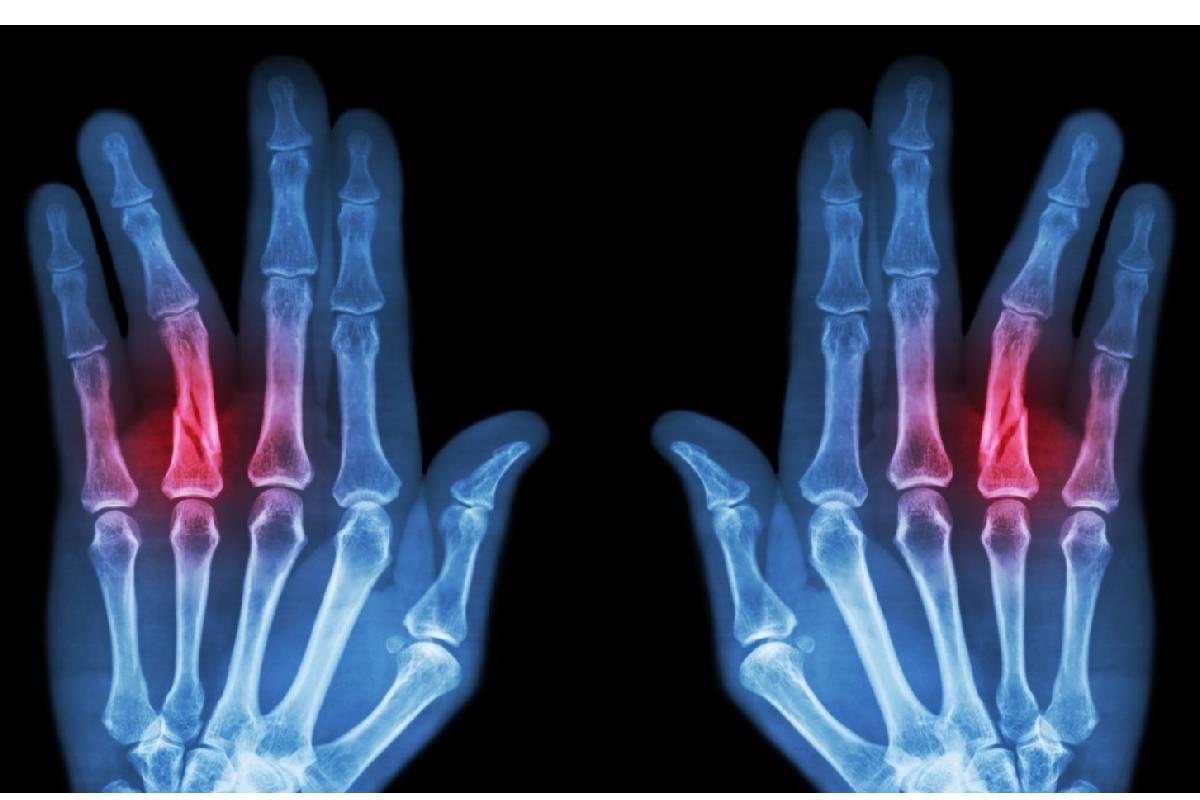 شکستگی انگشت دست