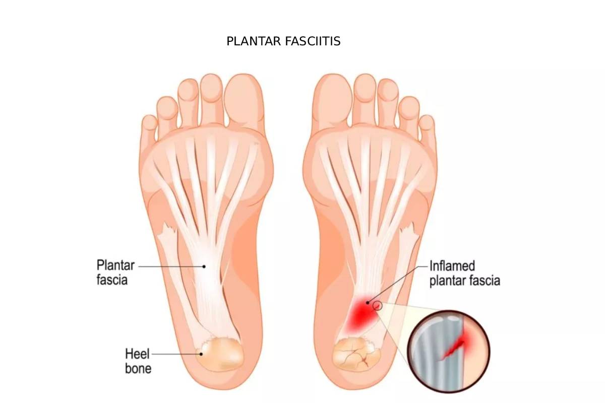 فاشیای کف پا