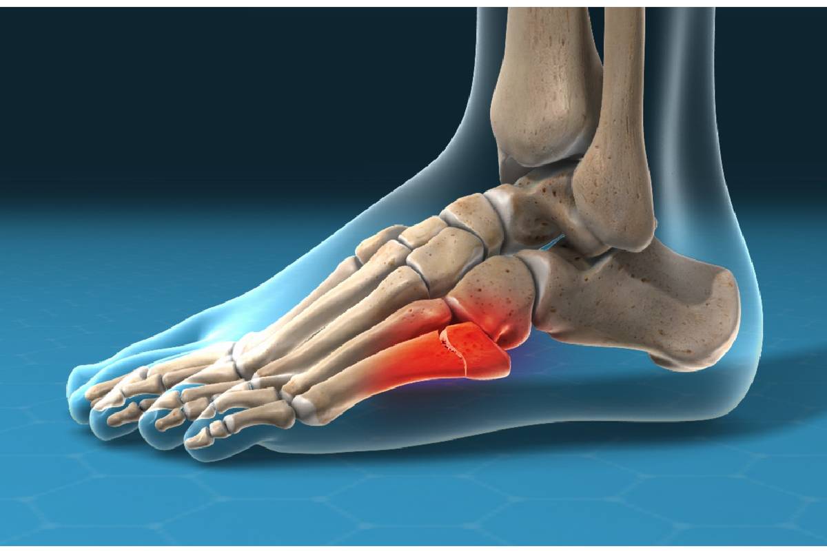 شکستگی جونز