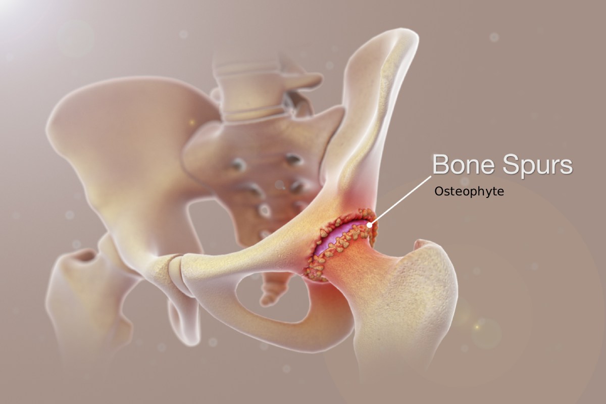 استئوفیت چیست