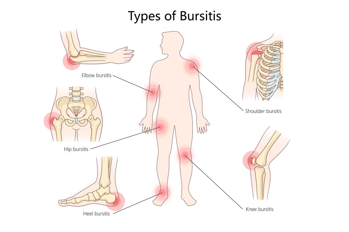 انواع بورسیت