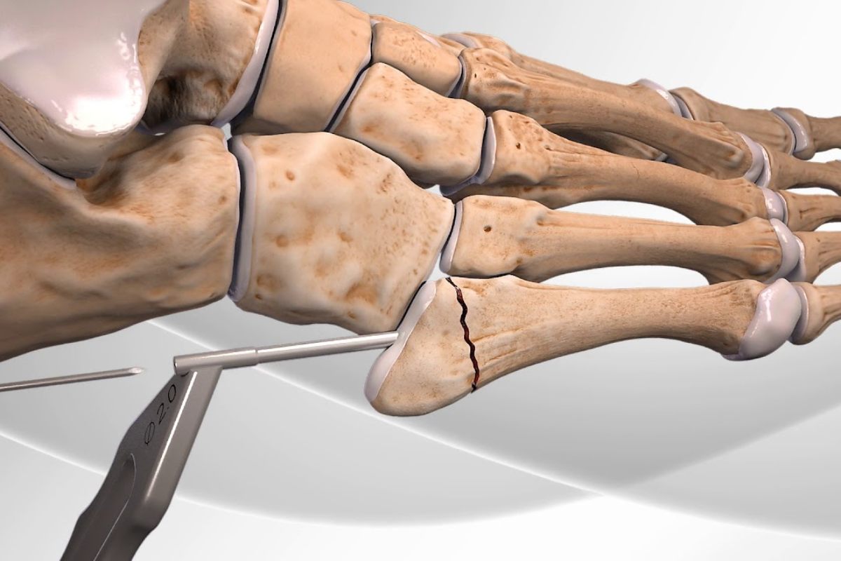 انواع شکستگی جونز