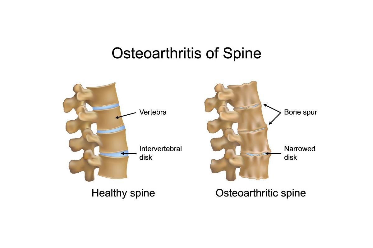 خار استخوانی چیست