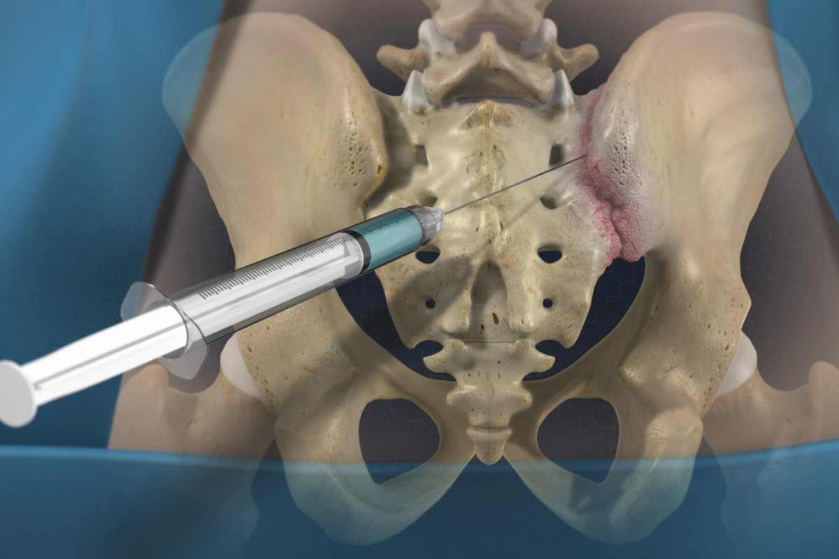 درمان اختلال مفصل ساکروایلیاک