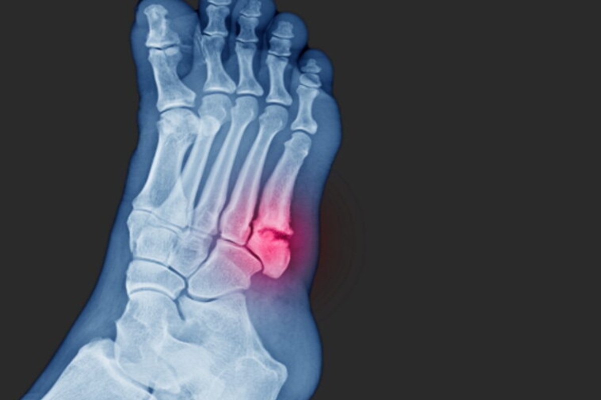 شکستگی جونز چیست