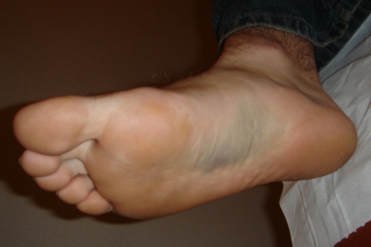 علائم التهاب فاشیای کف پا