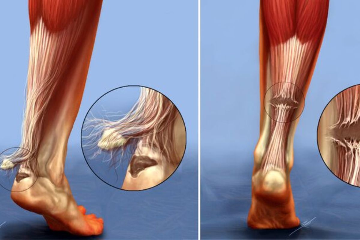 علائم پارگی تاندون مچ پا