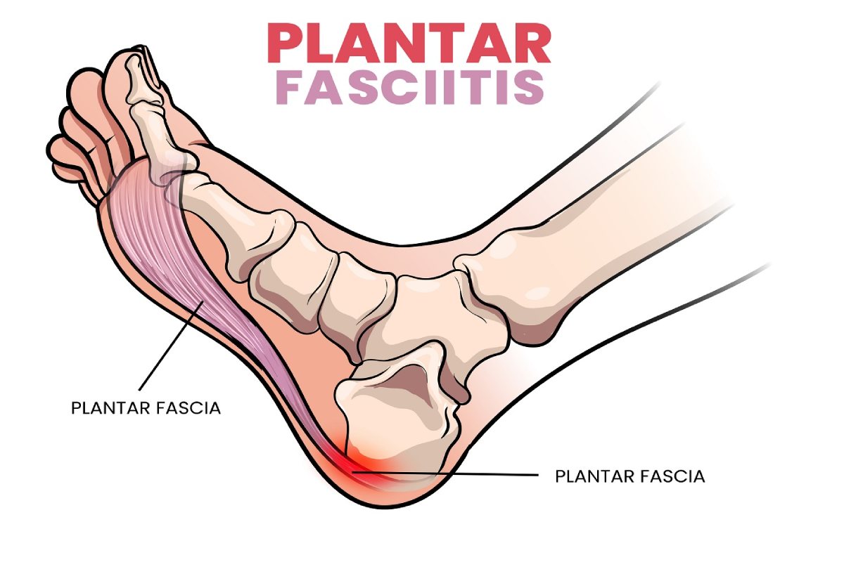 فاشیای کف پا چیست