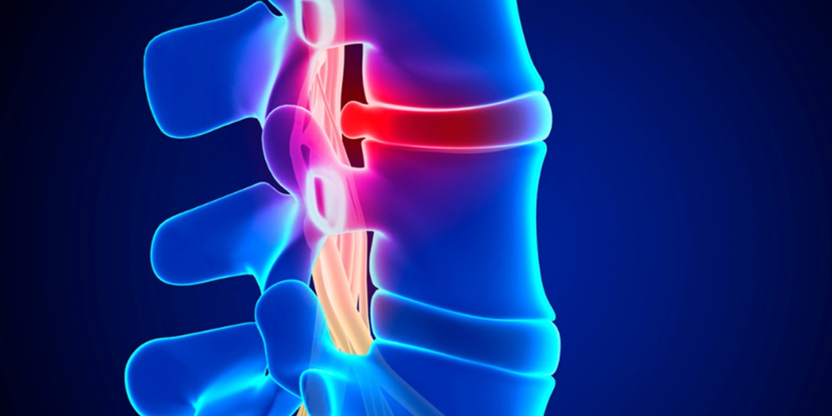 لیزر برای دیسک کمر