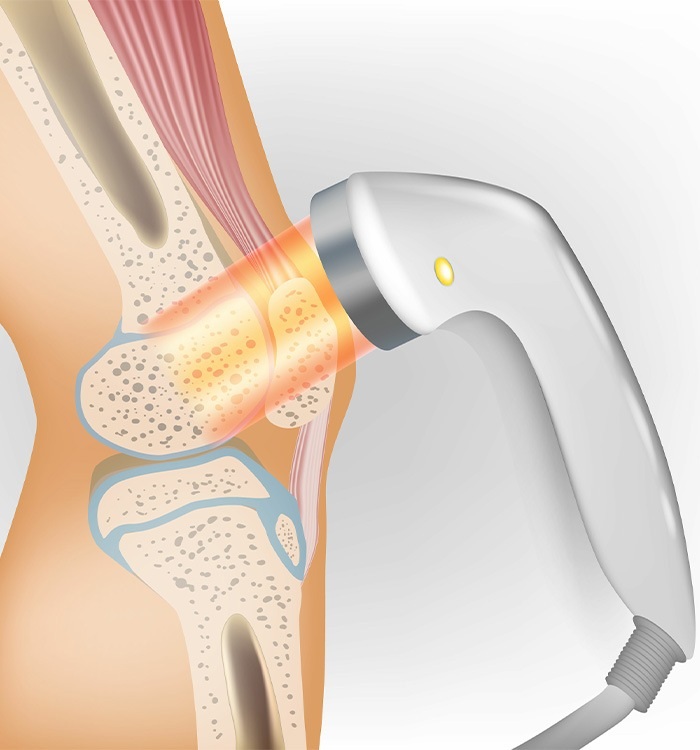 لیزر پرتوان برای پارگی مینیسک زانو
