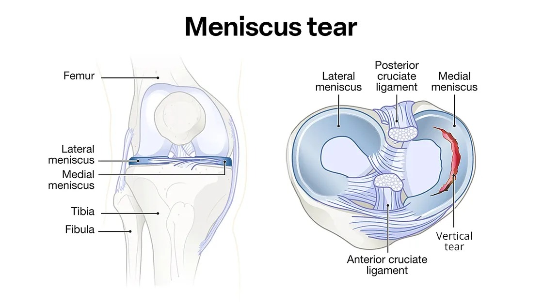مینیسک زانو و دلایل پارگی آن