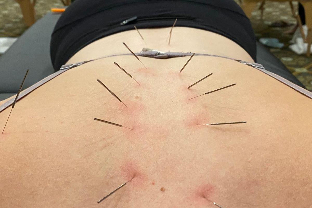 نحوه عملکرد سوزن خشک برای دیسک کمر