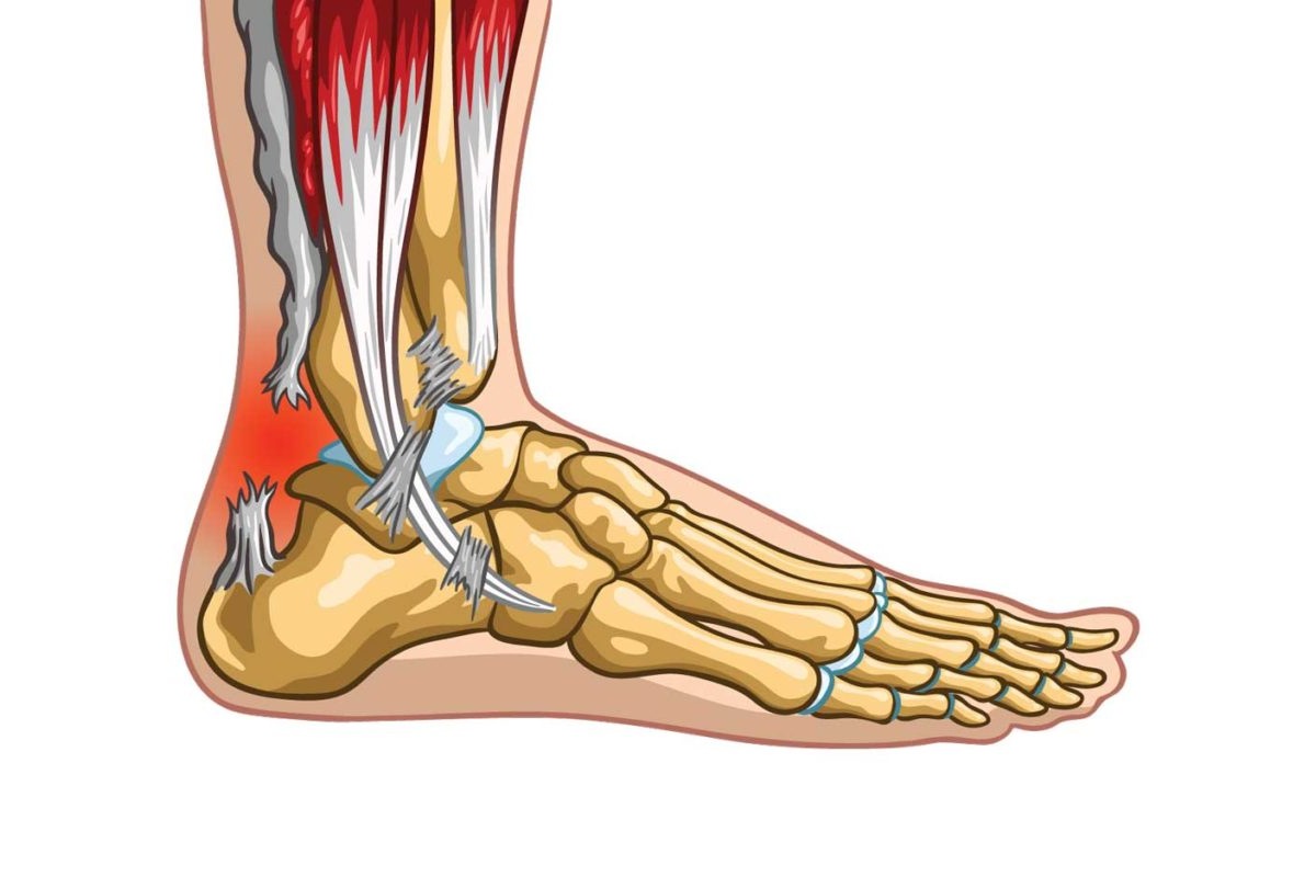 پارگی تاندون مچ پا چیست
