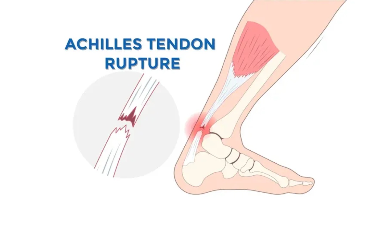 پارگی تاندون مچ پا