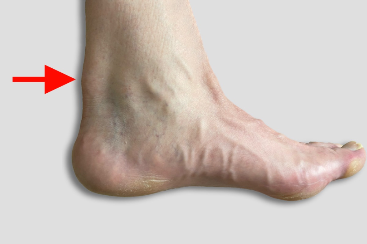 پیشگیری از پارگی تاندون مچ پا