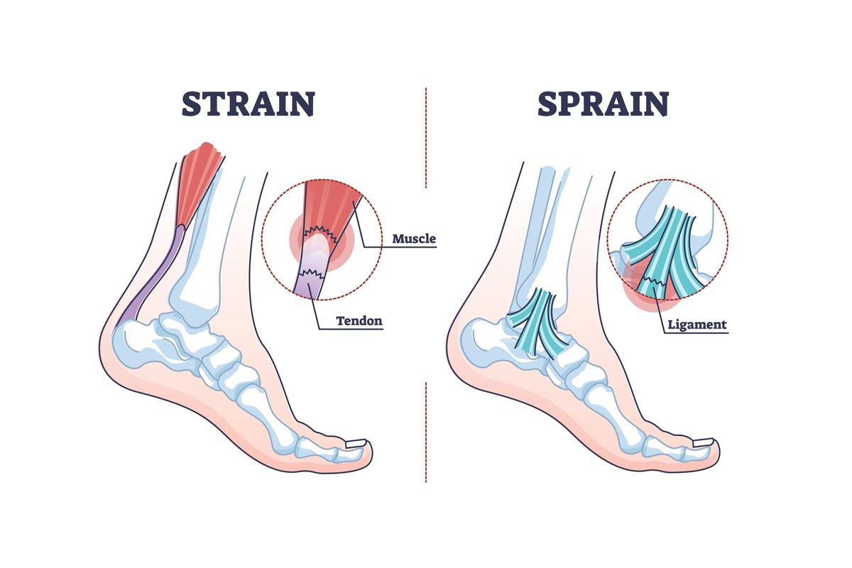 کشیدگی تاندون مچ پا