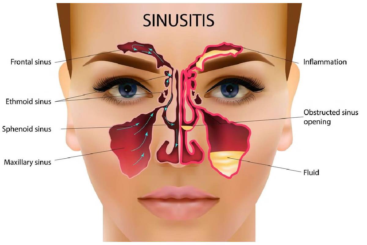 درمان سینوزیت با فیزیوتراپی