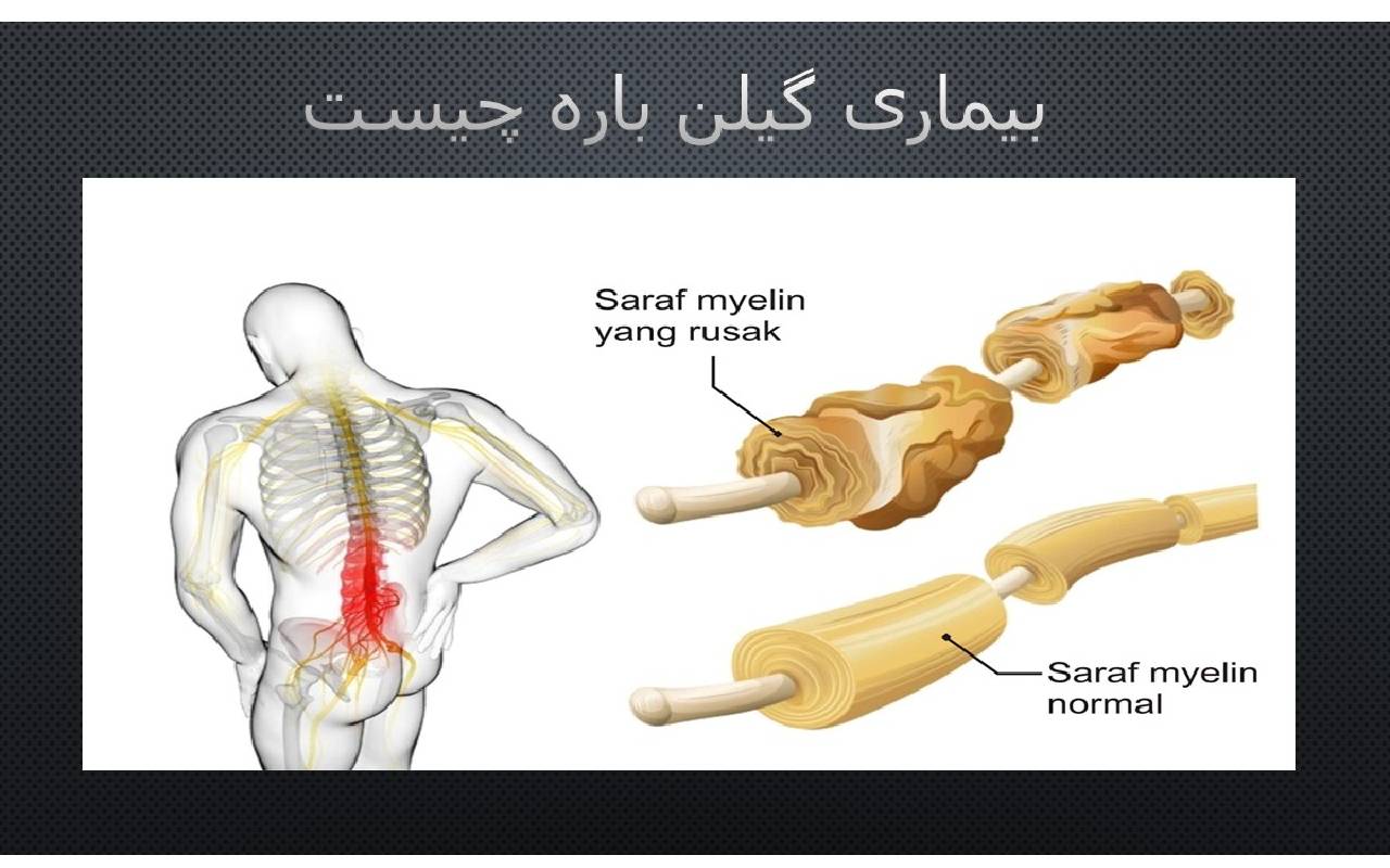 سندروم گیلن باره چیست