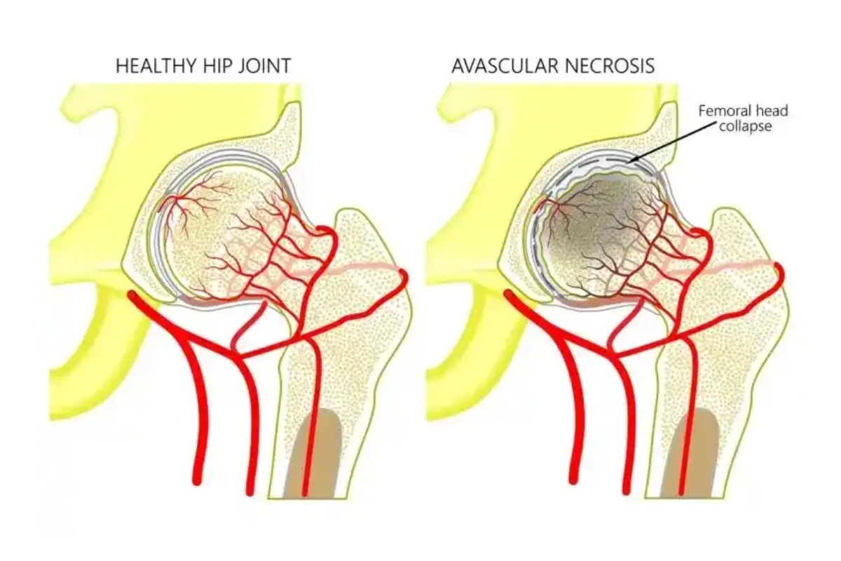 نکروز آواسکولار سر استخوان ران