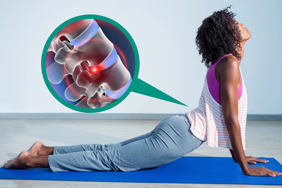 کمردرد ناشی از دیسک خشک