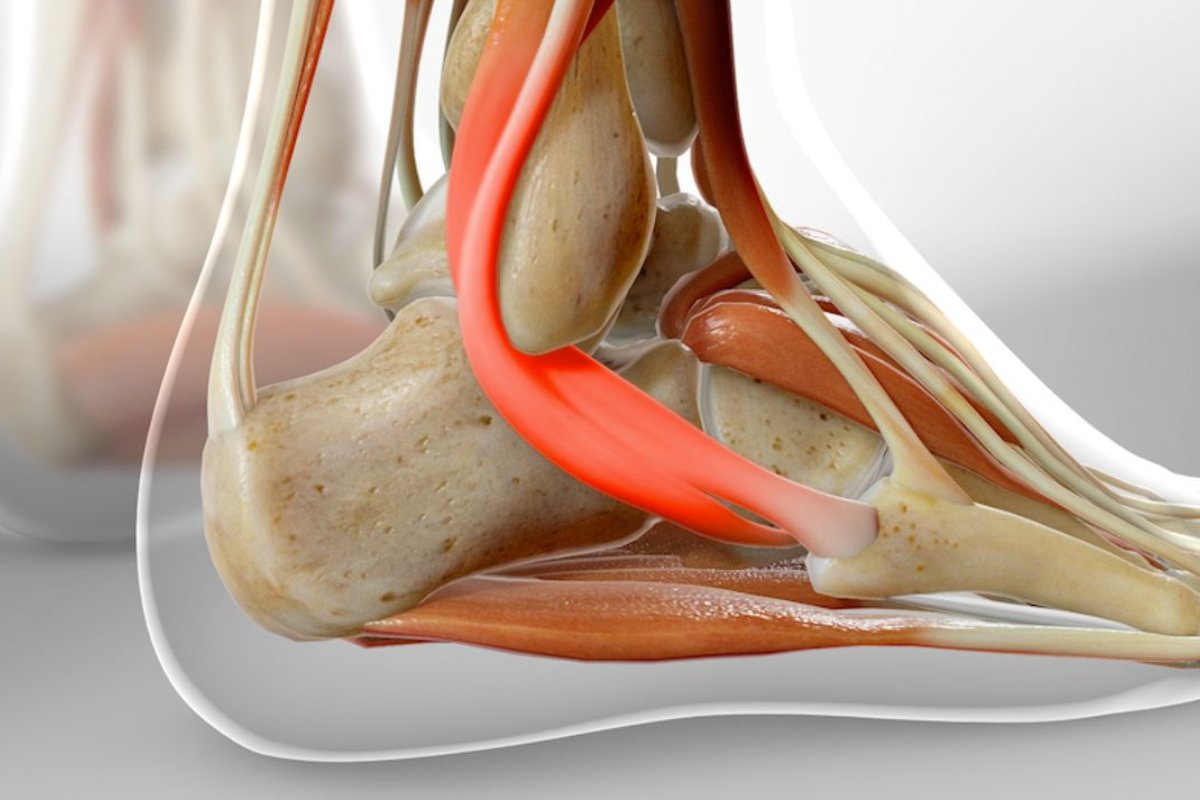 انواع تاندونیت
