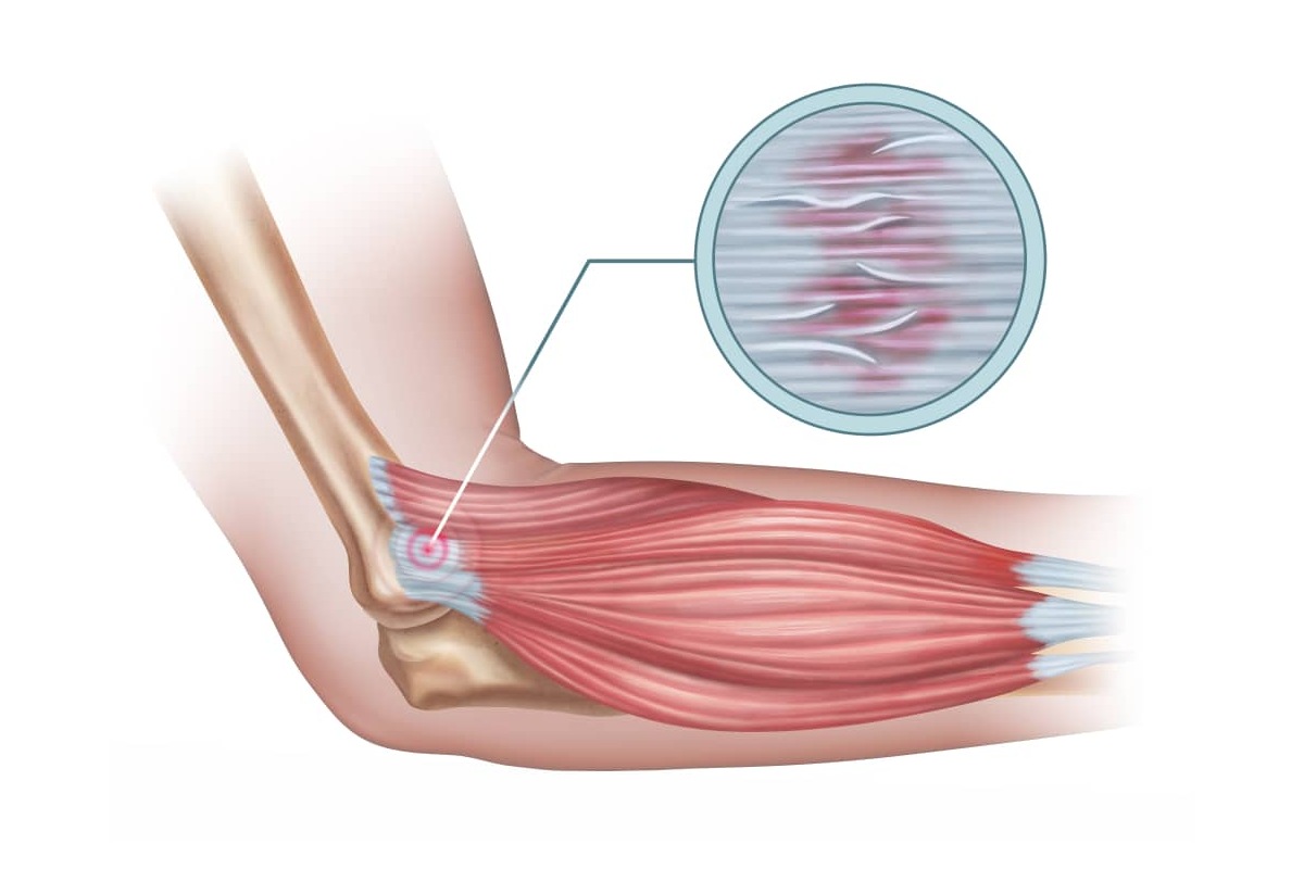 تاندونیت چیست
